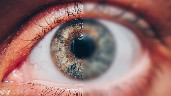 ADHD does not cause vision problems, and vision problems do not cause ADHD. image shows an eye close up and half of the eye is blurry