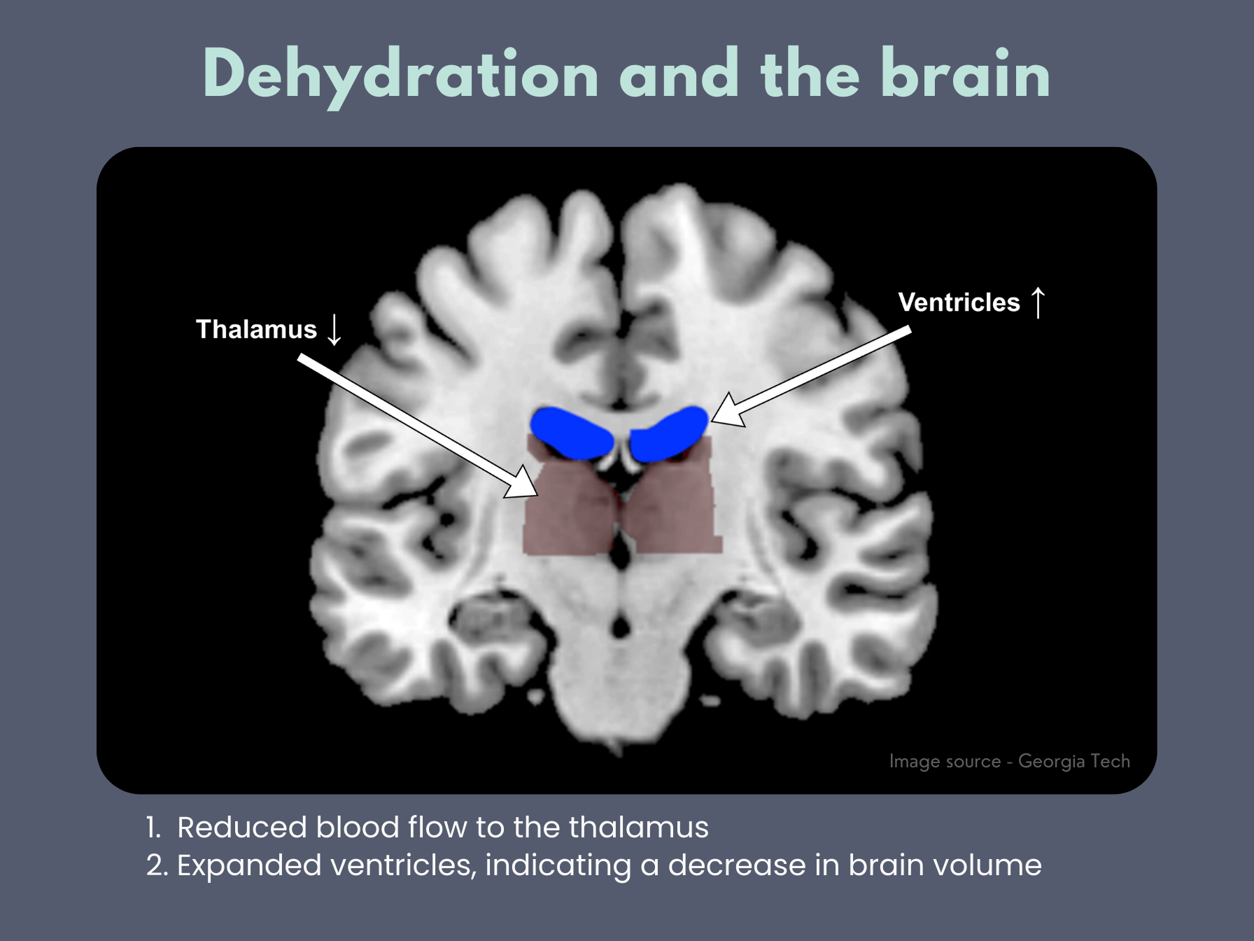 Dehydration and the brain. Image from georgia tech shows a brain scan highlighting expanded ventricles and decreased thalamus blood flow